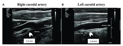 ultrasound measuring carotid intima-media thickness test|carotid intima media thickness measurement.